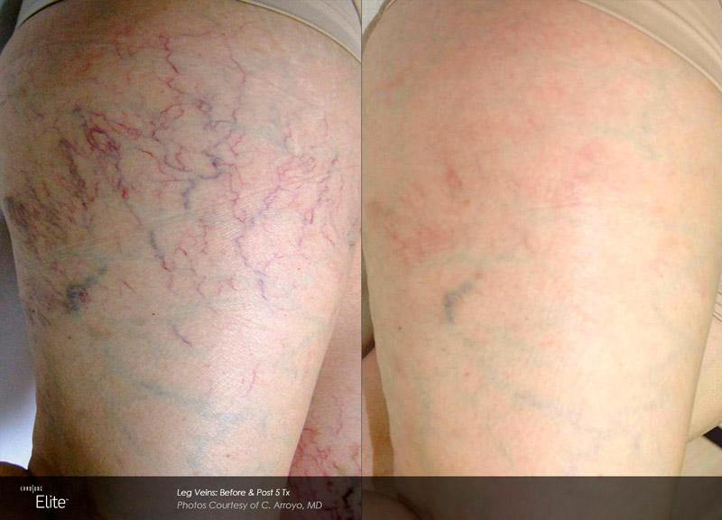 Leg Veins Before and After I Art of Skin