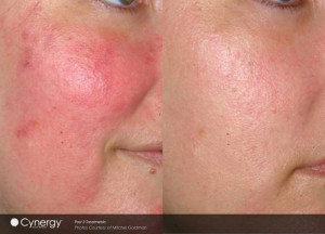 cynergy redness therapy