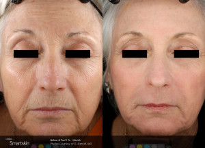 wrinkle reduction