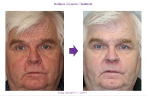 Redness Reduction Treatment