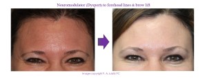 forehead lines & brow lift