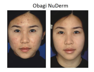 Obagi NuDerm