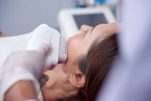 face laser hair removal
