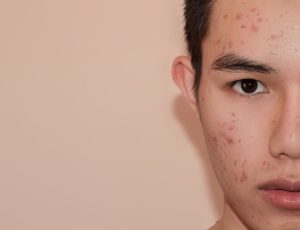 Treating Acne Scars