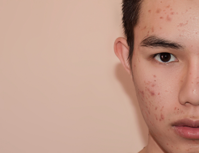 Treating Acne Scars